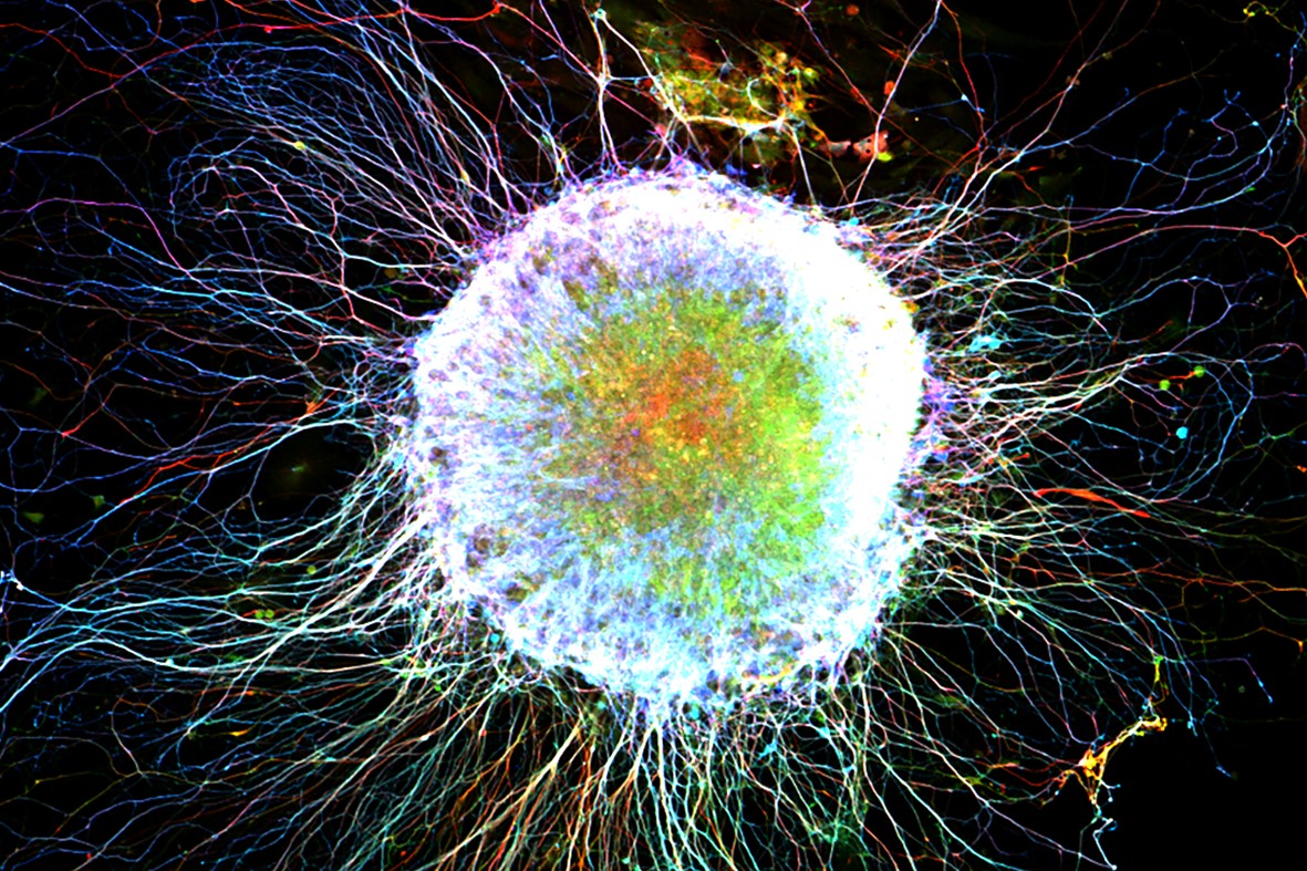 Breakthrough in ALS Research:Homeostasis m6A RNA Modification Opens New Opportunities for ALS Treatment and Biomarkers